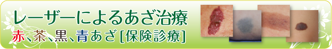 レーザーによるあざ治療